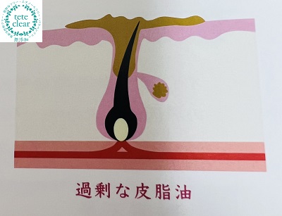 過剰な皮脂油